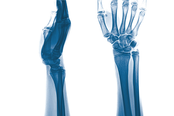 Perilunate dislocation occurs when the ulna bone detaches from the carpal bones in the wrist